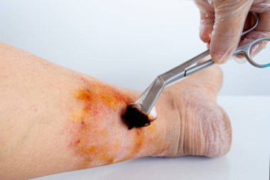 Doktorun elleri, yaralı cilde, kadın uzuvlarına, kronik dermatite, ağrılı kadın bacağına, egzama kızarıklıklarına, deri hasarına, enfeksiyon riskine ilaç sürüyor. 