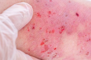 Doktor, bacağının alt kısmındaki büyük iyileşme yaralarını tedavi ediyor. Yaraları, yetişkin kadın hastalar, uzuvları, yara izleri, yara izleri, konsept tıbbi bakım, insan dokusu yenilenmesi.