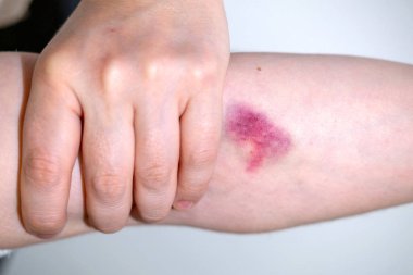 Kolunda morluk, kadın eli derisinde hematom, aile içi şiddet, fiziksel belirtiler suistimal ve acı, tıbbi tedavi, semptom sağlık durumu, sosyal sorunlar, sağlık hizmetleri.