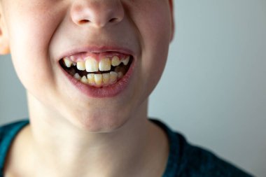 Çocuk denizde neşeyle yüzüyor, yaz tatilinin tadını çıkarırken su güvenliği becerilerini öğreniyor, çocuk deniz dalgalarında oynuyor, kaygısız ve mutlu, ebeveynler güvenliği ve boğulma riskini göze alıyor. 