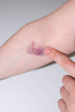 Tıbbi işlemden sonra kadın el donörü derisinde yakın plan morarma, dirsek bölgesinde kan alma, kan bağışı, sağlık kontrolü, kan testi prosedürü, tıbbi durum