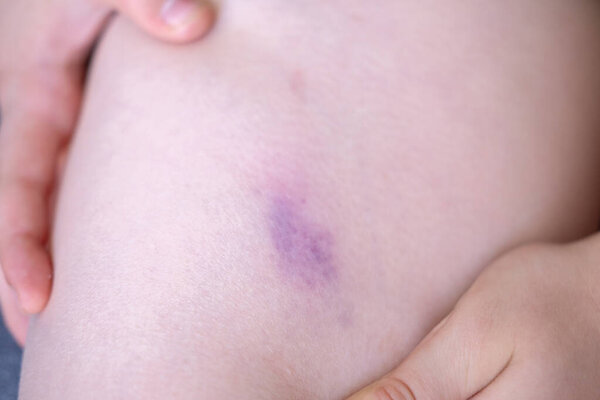 Крупным планом маленький мальчик держит больную ногу, человеческую кожу с большим красным и заметным фиолетовым синяком, показывая изменение цвета от травмы, состояние здоровья, безопасность детства