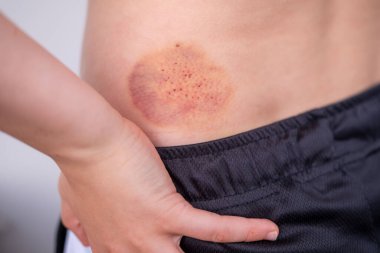 Yakından bakıldığında küçük bir çocuk hassas tarafını tutuyor. İnsan derisinde büyük kırmızı ve belirgin morluklar var. Sırt ya da kalça bölgesinde yaralanma, tıbbi durum ve çocukluk güvenliğinden kaynaklanan renk değişimi görülüyor.