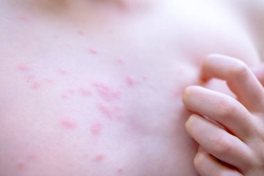 İnsan derisi kırmızı, kaşındıran kızarıklıklarla kaplı 11 yaşında vücudunda ısırık ve kızarıklık, egzama, suçiçeği, alerjik reaksiyon veya böcek ısırıkları, sivrisinek ısırıkları, sağlık sorunları olan bir çocuk.