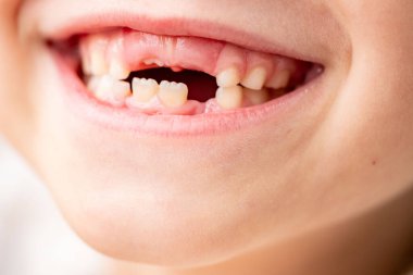Mutlu, beyaz, komik, dişsiz 6 yaşında bir kız, bebek dişli, gülümseyen çocukluk anı diş perisini bekliyor, büyüyor, sevimli, dişsiz gülümseme, masumiyet ve neşe dolu çocukluk.
