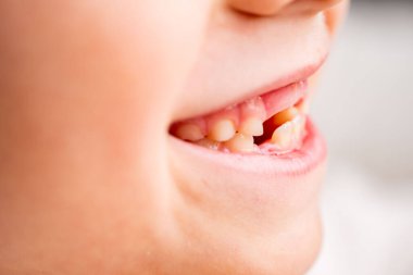 Mutlu, beyaz, komik, dişsiz 6 yaşında bir kız, bebek dişli, gülümseyen çocukluk anı diş perisini bekliyor, büyüyor, sevimli, dişsiz gülümseme, masumiyet ve neşe dolu çocukluk.