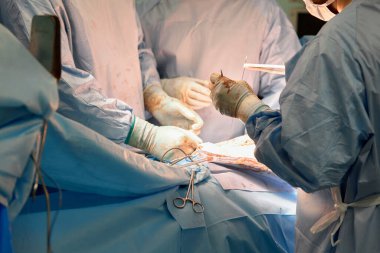 Pediatrik cerrahların yakın çekim elleri endoskopik ameliyatlarda laparoskopik portlar kullanarak ameliyat yaparlar. Steril bir ameliyathanede. Pediatrik cerrahi, çocuklarda kasık fıtığı tedavisi.