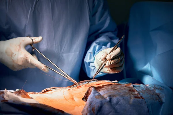 手术结束时 外科医生给病人缝好了皮肤 有选择的重点 医生们手拿无菌手套 用针头和线在人的皮肤上缝上伤口 — 图库照片