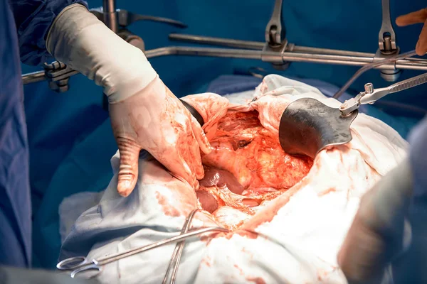 Detailní Záběr Rukou Chirurgů Během Operace Otevřeném Břiše Pacienta Sterilní — Stock fotografie