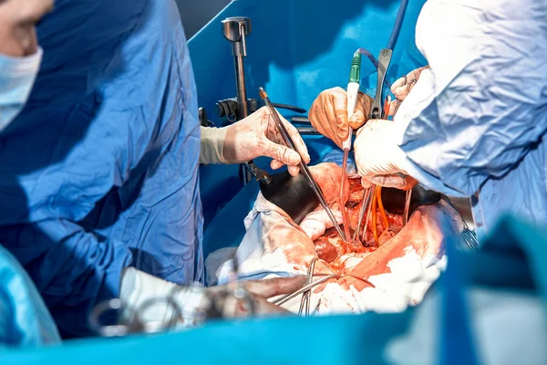 Primer Plano Las Manos Los Cirujanos Durante Una Operación Abdomen — Foto de Stock