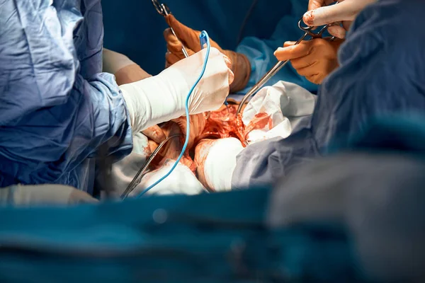 Sebészek Csoportja Műtőben Sebészeti Felszereléssel Közelkép Kezekről Amint Sebészeti Eszközöket — Stock Fotó