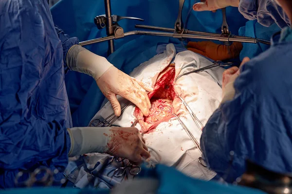 Sebészek Csoportja Műtőben Sebészeti Felszereléssel Közelkép Kezekről Amint Sebészeti Eszközöket — Stock Fotó
