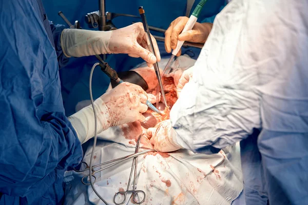 一组带着外科设备的外科医生在手术室里 手持手术器械的手的特写 对一个人的内部器官进行外科手术 实际运作 — 图库照片