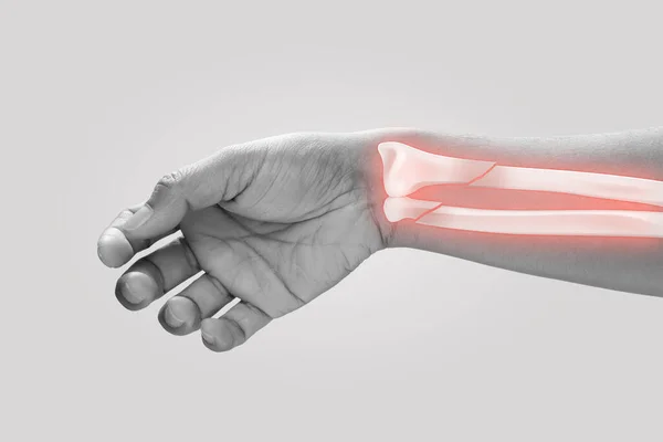 Ulna Fracture Gray Background — Stock Photo, Image