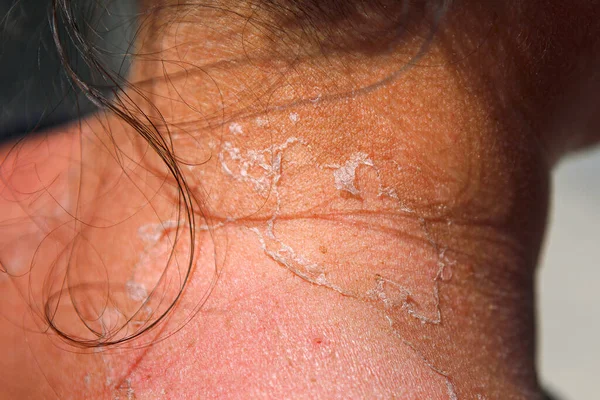 Neck peeling skin after sunburn . Body part with peeling skin