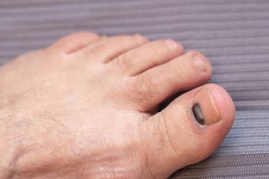 Ayak tırnağında deri altı hematoma ya da tırnak tümörü belirtileri var.