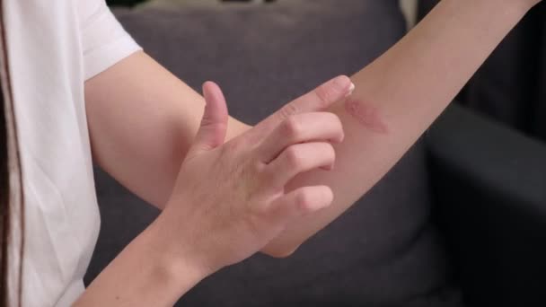 Close Mulher Branca Jovem Aplicando Creme Remoção Cicatrizes Para Curar — Vídeo de Stock