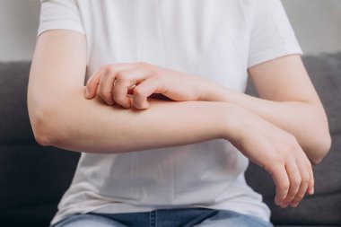 Atopik atopik alerjik reaksiyonu olan genç, beyaz bir kadın, kolunda böcek ısırıkları, kaşındıran bir el, kaşındıran kırmızı bir nokta ya da cildinde kızarıklık var. Sağlık, tedavi, dermatoloji konsepti