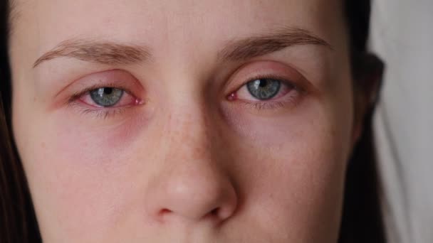 Nahaufnahme Einer Aufgebrachten Jungen Kaukasischen Frau Die Unter Augenschmerzen Leidet — Stockvideo