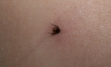 Ixodes ricinus, the castor bean tick. The parasite during the bite. Carrier Lyme disease and tick-borne encephalitis on the human skin. Male. clipart