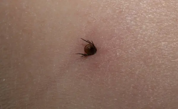 Ixodes ricinus, the castor bean tick. The parasite during the bite. Carrier Lyme disease and tick-borne encephalitis on the human skin. Male.