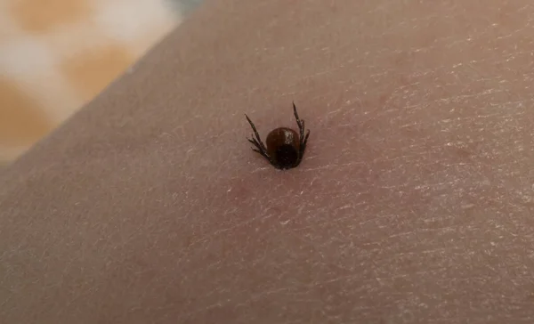 Ixodes ricinus, the castor bean tick. The parasite during the bite. Carrier Lyme disease and tick-borne encephalitis on the human skin. Male.