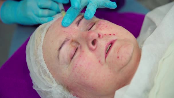 高齢の女性は診療所に横たわり 化粧品師は顔の治療を行っています 化粧品師は 彼女の顧客の眉毛の周りに一連の小さな注射を行っています 血液の新鮮な痕跡は — ストック動画