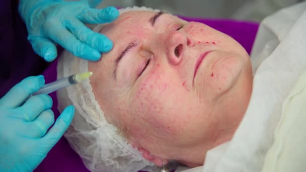 化粧品学者は メソセラピー治療を行っている間 顧客の皮膚の下に針を挿入します その女性は目を閉じて 医者に何かを言った 小さな血液滴が見える — ストック動画