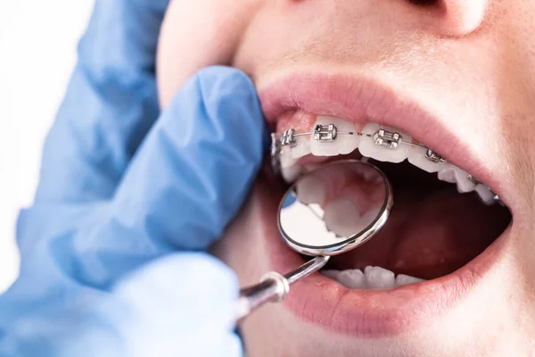 A close-up of a dental brace, a dentist-orthodontist checks the tension of the braces.