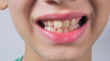 Çocuk dişlerini gösteriyor. Ekstra sivri dişler çıkar. Köpekbalığı dişleri. Dişçilere. Bebek dişleri. Kök dişleri. Tıbbi muayene. Çocuk dişçiliği. Yüzün bir parçası. Yakın plan..