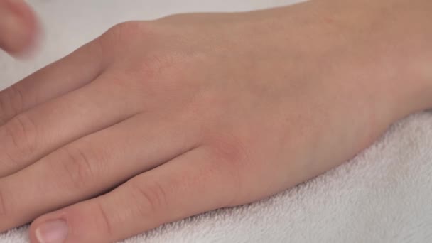 Menina Mulher Esfrega Eczema Suas Mãos Com Pomada Cura Especial — Vídeo de Stock