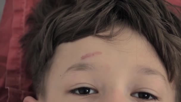Рана Лбу Мальчиков Мальчик Растирает Голову Болит — стоковое видео