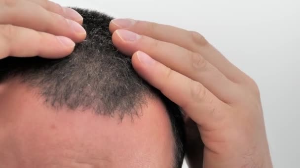 Zbliżenie Człowieka Stojącego Przed Lustrem Patrzącego Jego Przerzedzone Włosy Problemy — Wideo stockowe