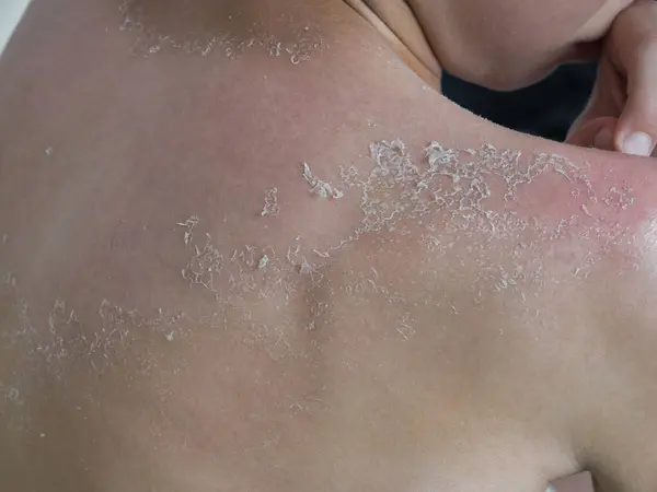 Texture of irritated skin with cracks of dead cells and redness after sunburn and allergies on the human body. Skin care concept. Handsome guy got sunburn and got tan lines on his back.