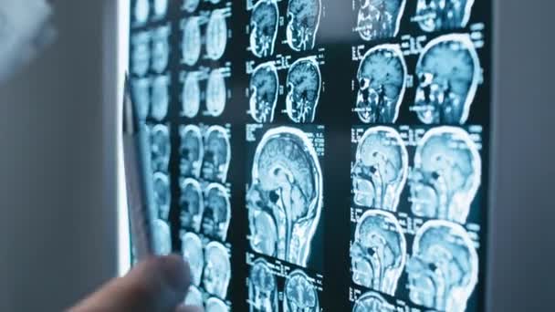 Selektivt Fokus Närbild Oigenkännlig Kirurg Inspektera Patienter Hjärna Röntgen Bild — Stockvideo