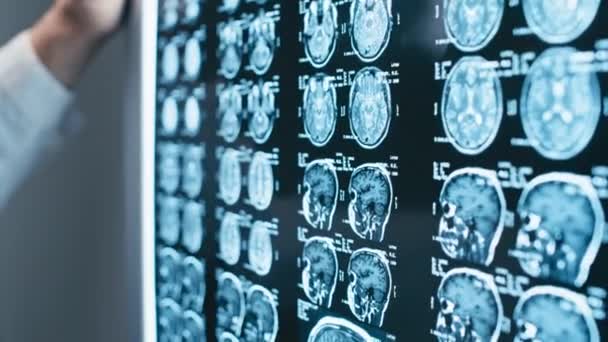 ライトボックスパネルに配置された患者の脳X線画像のクローズアップショットを絞り込む選択的な焦点 — ストック動画