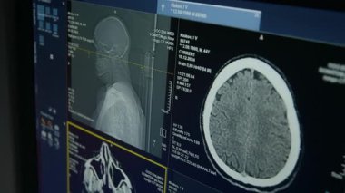 Hasta beyninin MRI taraması ve eksensel, sagittal bölümlerdeki kafatası taramasıyla bilgisayar ekranını kapatıyorum. Muayene sırasında nöroşirürji kliniğinde radyoloji uzmanının masasında.