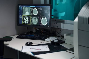 İnsan beyninin detaylı taramalarıyla bilgisayar monitörlerini gösteren tıbbi büro, muayene sırasında tanı sürecini vurguluyor.