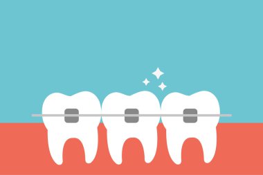 Diş teli olan beyaz dişli vektör düz çizim. Diş ısırığının hizası. Diş kliniği servisi, kozmetik odontoloji, diş düzeltme ve ortodontik prosedür konsepti..