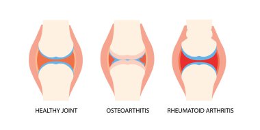 Joint anatomy, osteoarthritis and rheumatoid arthritis infographic with anatomical illustrations clipart