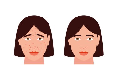 Face with acne and without acne vector clipart