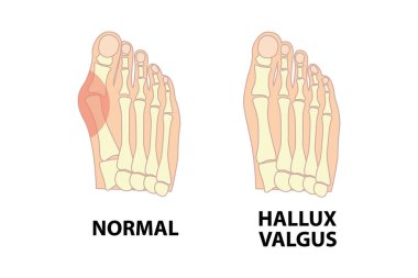 Sağlıklı ayak ve ayak olan şişik. İnsan anatomisi. İskelet