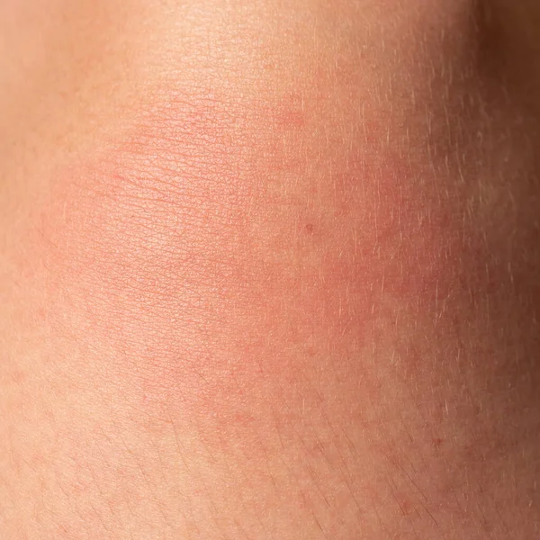 Allergie Auf Den Menschlichen Körper Und Rötung Durch Wespenstich Rötung — Stockfoto