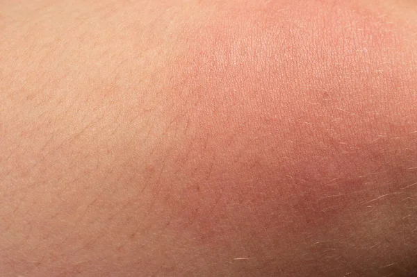 Alergia Corpo Humano Vermelhidão Picada Vespa Vermelhidão Picada Close — Fotografia de Stock