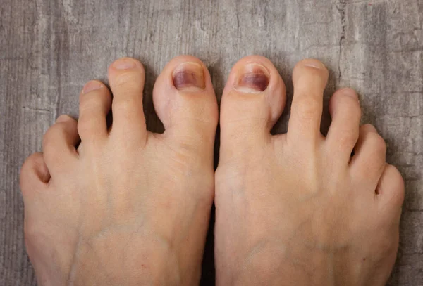 Feet Floor Damaged Nails Bruise Thumb Nail Barefoot Close Nail — Stock Photo, Image
