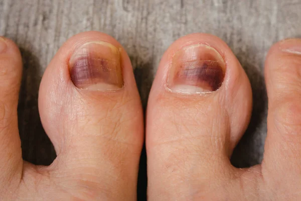 stock image Feet on the floor. Damaged nails. Bruise under thumb nail. Barefoot close up. Nail illness. Health treatment. Foot care concept. Foot infection. Injured feet. Body care concept.