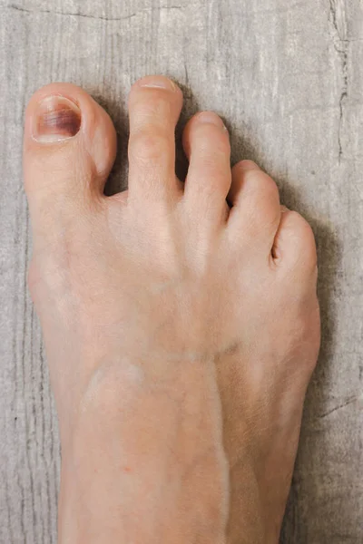 右脚踩在地板上被损坏的钉子拇指钉下的青肿 赤脚关门 我得了脑病保健治疗 脚部护理的概念 脚部感染受伤的脚身体护理概念 — 图库照片