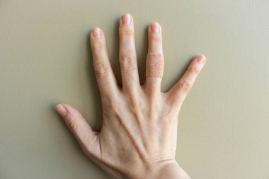 Alçıyla yaralanmış bir el. Parmağında bej alçı olan bir avuç içi. Tıbbi tedavi konsepti. Kabarcık ve tekstil sıvası. Sağlık hizmetleri. Kabarcık koruması. Kadın parmağında esnek bant. Çıplak manikür.. 