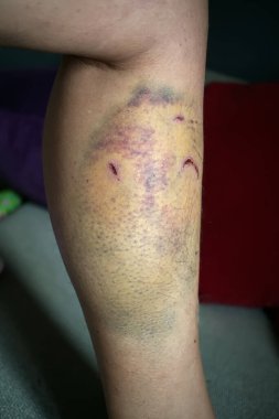 Köpek bacağında hematom ve diş izleri var.