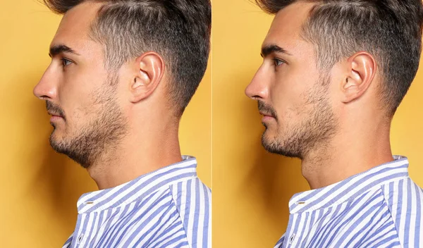 Double chin problem. Collage with photos of man before and after plastic surgery procedure on yellow background